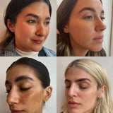 Brow Lift