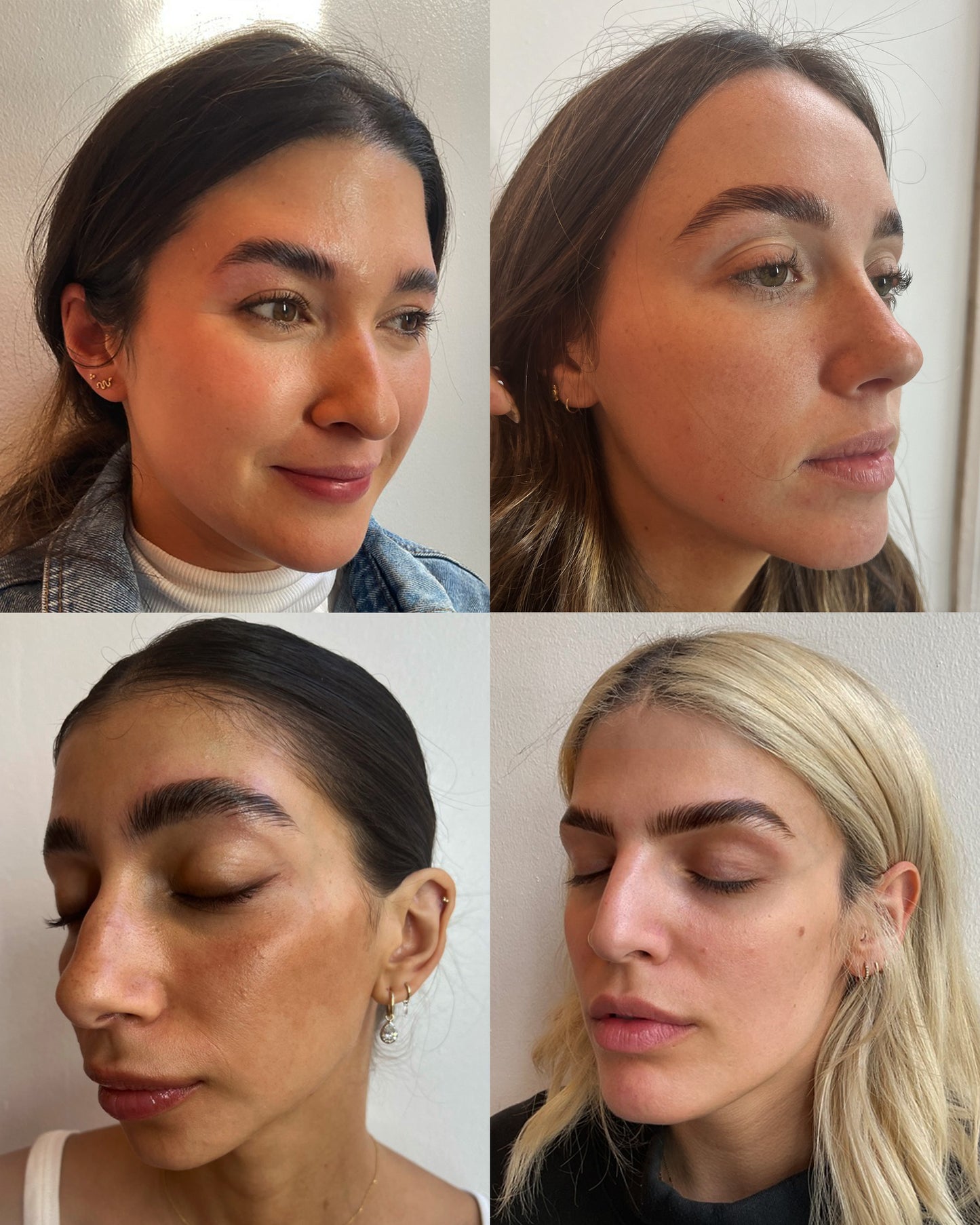 Brow Lift